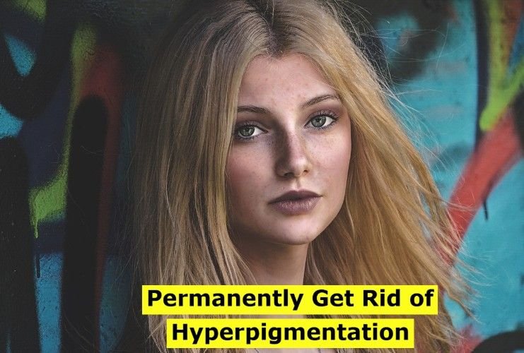 of Hyperpigmentation
